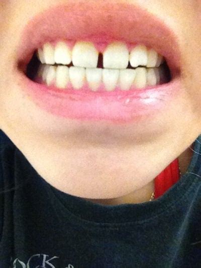 Maybe you would like to learn more about one of these? What Would Be the Best Way to Get Rid of my Gap? (photo ...