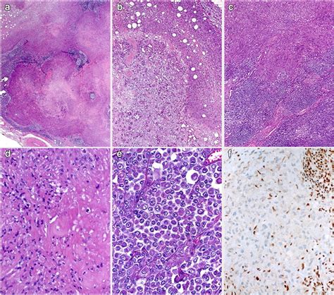 Classical Epithelioid Sarcoma Shows Multinodular Growth With Extensive