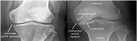 Frontiers Automatic Detection And Classification Of Knee