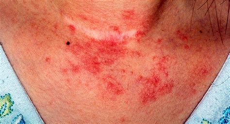 If you are experiencing any of these signs and. Eczema Symptoms and Diagnosis