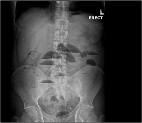 An Abdominal X Ray Divulging Multiple Air Fluid Levels Within The