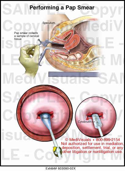 The test doesn't diagnose cancer, but rather looks for abnormal cervical changes (cervical dysplasia)—precancerous or cancerous cells that could. Medivisuals Performing a Pap Smear Medical Illustration