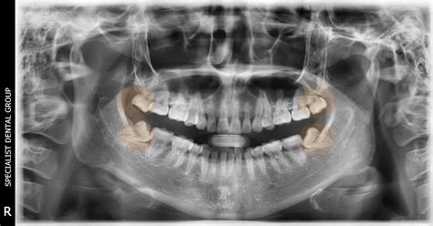 A Comprehensive Guide On Wisdom Teeth Pain And Problems
