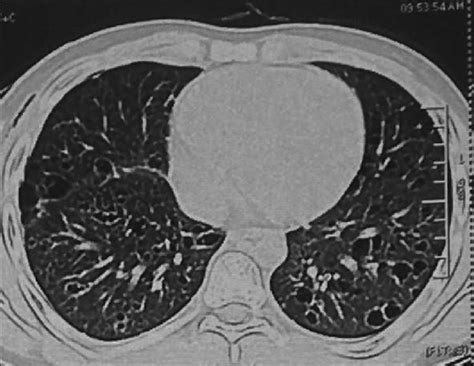 Computed Tomography Thorax Lung Window Section Showing Multiple