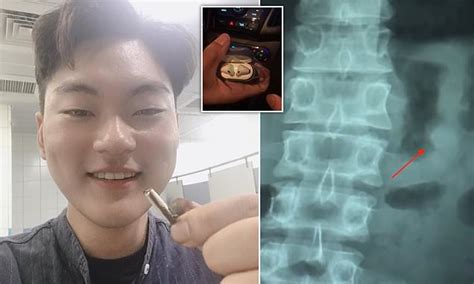 Man Accidentally Swallows An Apple AirPod And It STILL WORKS After It