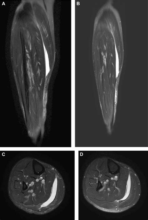 E Mri Of The Right Calf A And B Coronal T2 Weighted Fat Suppressed