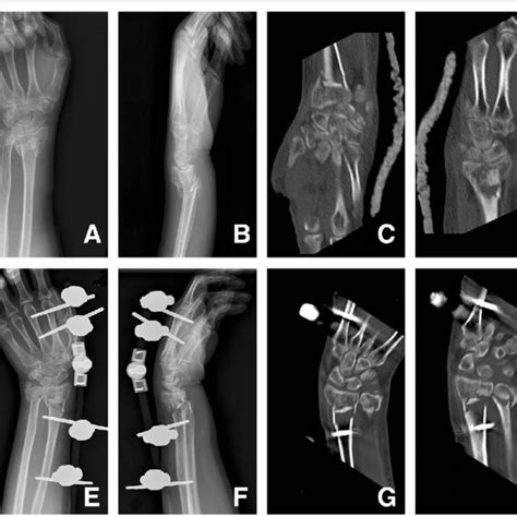 Ao C31 Fracture Of The Left Distal Radius Occurred In A 37 Year Old