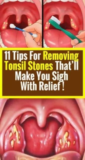 Tips On Removing Tonsil Stones With Relief Medicine Health Life