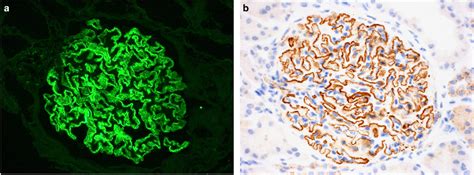 Membranous Glomerulopathy With Dual Positive Staining A And B This