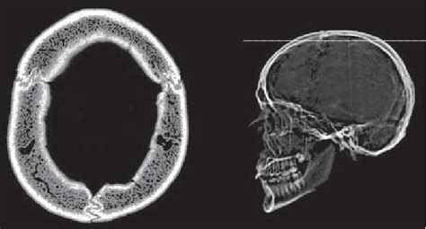Axial Ct Scan Of The Cranium And The Topogram Showing The Section Level