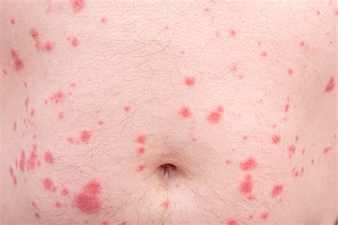 Closeup Of Skin Disorder As Hives Or Allergy Human Body With Rash Stock