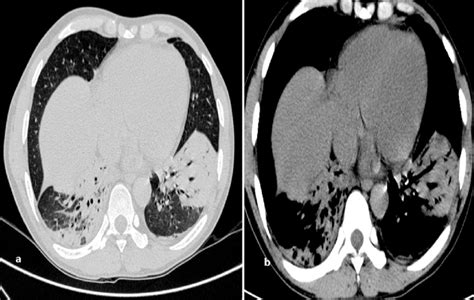 Bacterial Pneumonia Hrct At Lung A And Mediastinal Window Settings Download Scientific