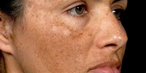 Hyperpigmentation Causes Hyperpigmentation Treatment