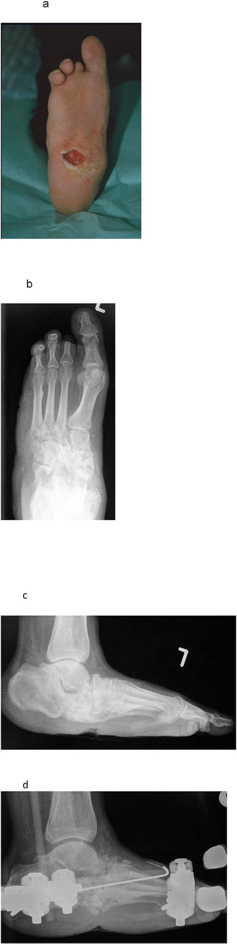 3a Charcot Foot With Osteomyelitis And Plantar Ulcer Fig 3b Download Scientific Diagram