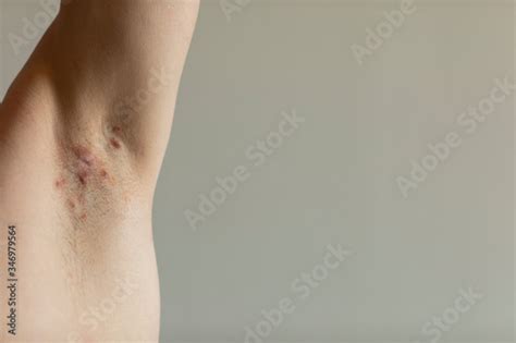 A Patient Diagnosed With Crohns Disease With Hidradenitis Suppurativa