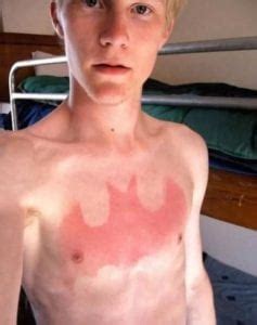50 Dreadfully Bad Sunburns