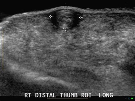 Subcutaneous Dermoid Cyst Ultrasound