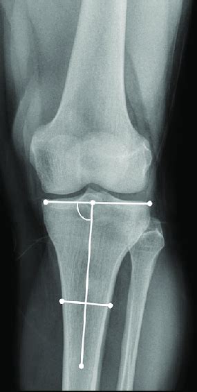 Demonstration Of Radiographic Measurement Of Medial Proximal Tibial