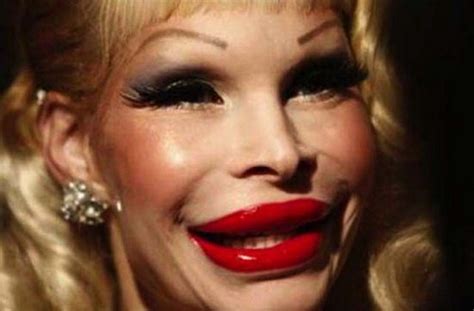 30 Horrifying Results Of Terrible Plastic Surgery Wtf Gallery Ebaum
