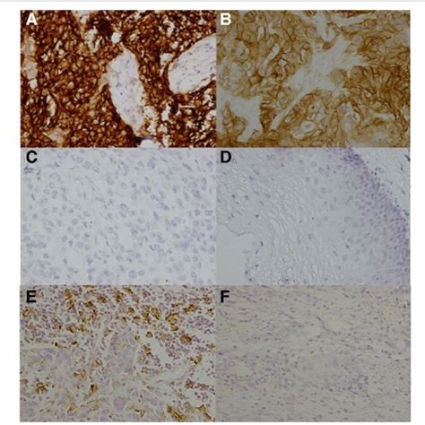 Pd L1 Expression In Esophageal Squamous Cell Carcinoma Escc Tumor