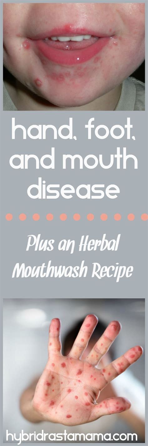 Hand Foot And Mouth Disease In Children An Herbal Mouthwash Recipe
