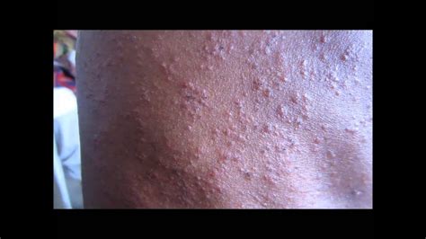 Heat Rash On African American Skin Severe Side Effects