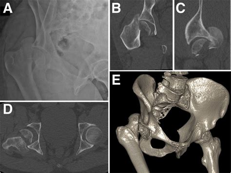 The Initial Anteroposterior Ap Pelvic X Ray 1a And Pelvic Ct Images