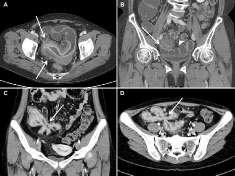 Computed Tomography Enterography Of Active Crohns Disease Axial Image