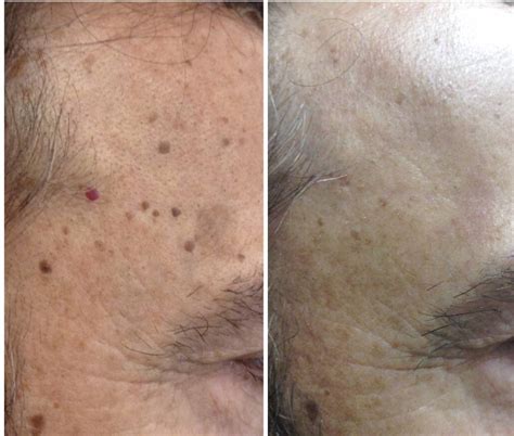 Keratosis pilaris is a common skin condition in youth that is characterized by a blanket of bumps (papules) on the skin. Keratosis Removal - Services | Laser Looks
