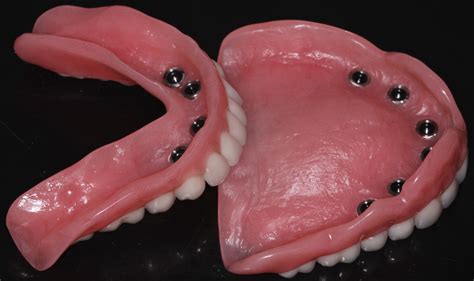 Do Dentures Have To Be Removed For Mri