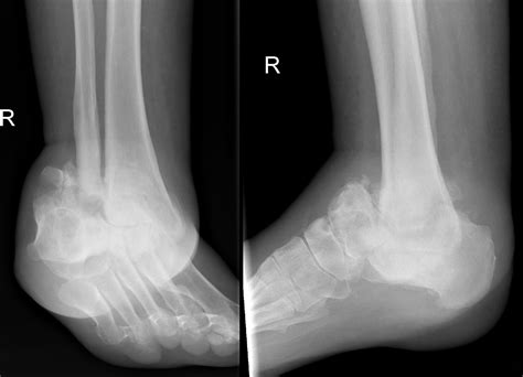 Neuropathic Joint Charcot Marie Tooth Disease Radiology At St