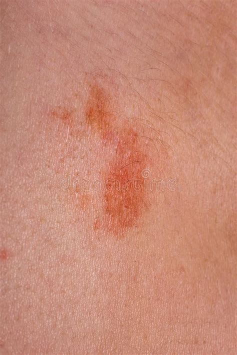 The Great Red Spot On The Skin Closeup Stock Image Image Of Melanoma