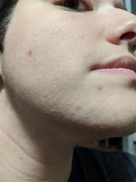 Acne Colorless Bumps Covering My Jaw All The Way To My Upper Cheeks