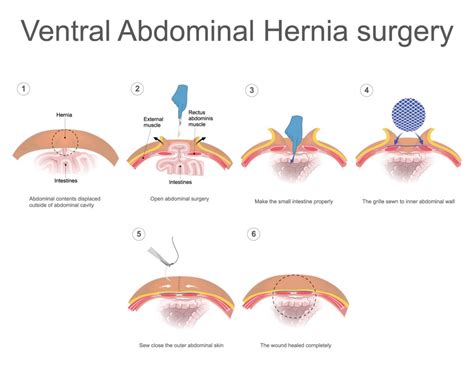 21 Ventral Hernia Ideas Umbilical Hernia Hernia Repair Abdominal Hernia