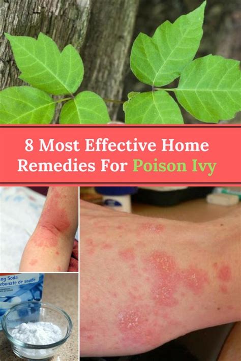 Best Way To Cure Poison Ivy Rash
