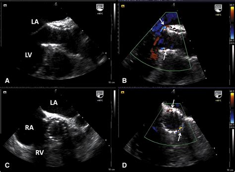 Transcatheter Aortic Valve Implantation In A Patient With Severe Native