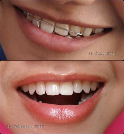 Persediaan sebelum & semasa pakai braces. e.Z.m.@.L.i.Z.@: Perihal Gigi dan Braces