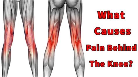 Pin On What Causes Pain Behind The Knee Pain Behind Knee Aza Food For