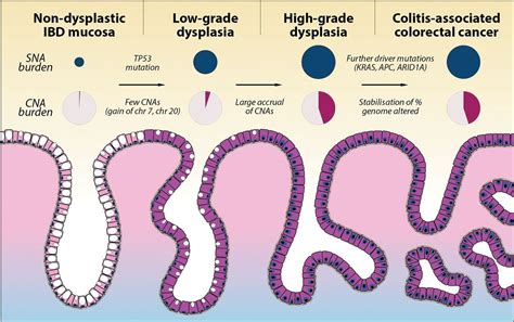 Evolutionary History Of Human Colitis Associated Colorectal Cancer Gut