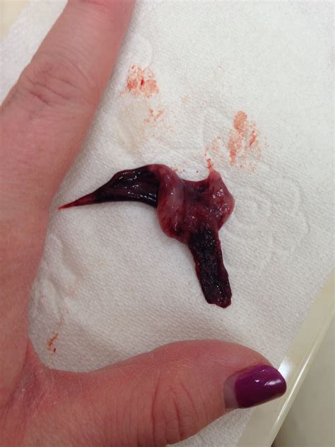 Complications of massive transfusion (poor blood clotting, low body temperature, and low calcium and potassium levels). Is this a normal period clot??(Gross pics) - Weddingbee