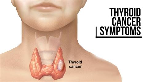 Thyroid Nodules On Neck Pictures To Pin On Pinterest Thepinsta