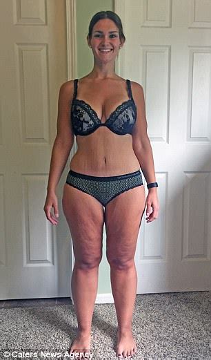Obese Michigan Woman Loses 151lbs Thanks To Gastric Band Daily Mail