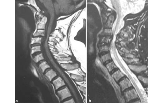 Mri Scan Of The Cervical Spine A The T2 Weighted Image Confirms The