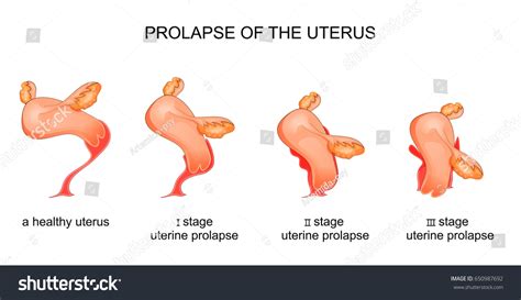 Vector Illustration Stage Uterine Prolapse Stock Vector Royalty Free