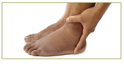 Swelling And Skin Discoloration Of The Leg And Ankle A Race Against Time