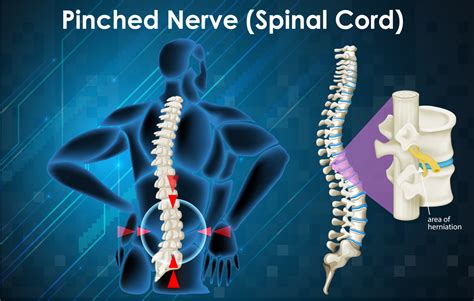 Can A Chiropractor Treat Pinched Nerves Ogden Chiropractic