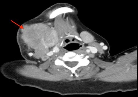 Cureus An Unusual Case Of Alveolar Rhabdomyosarcoma Of The Neck In An