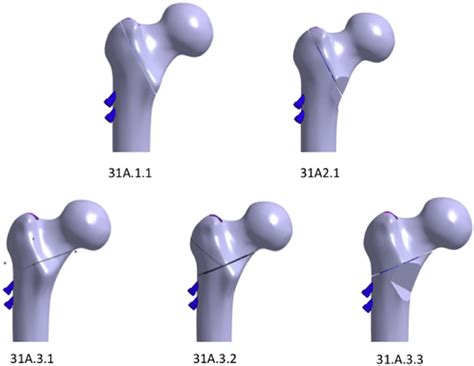 Fracture Models According To Aoota Classification System Download