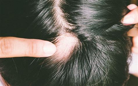 O Que é Alopecia Causas E Tratamentos Para Queda De Cabelo