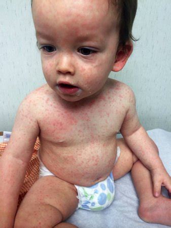 When you have eczema, your skin is inflamed and develops dry patches that flake off. Roseola? Dairy allergy? Does this rash look like something ...